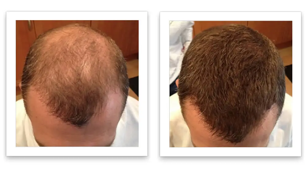 30ml Hair Growth Serum Essence Spray for Women and Men Anti Prevent Hair Loss alopecia Liquid Damaged Hair Growth Liquid