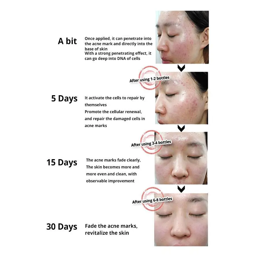 SOONPURE Выпариваемый раствор улитки возобновления 4PCS