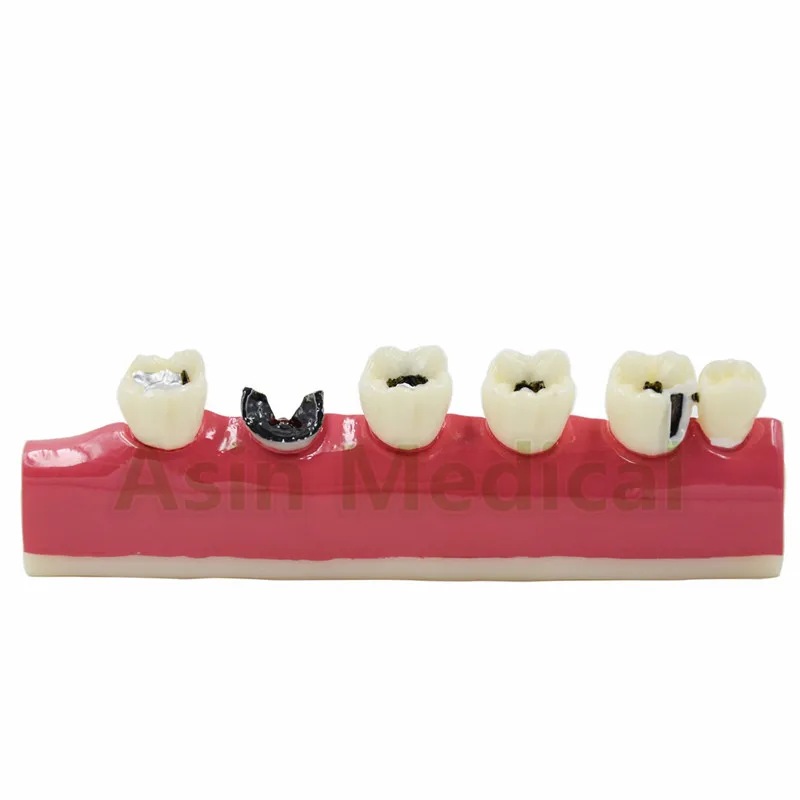 

DEASIN New Arrival Dental Caries Developing illusteation Tooth Model Demonstration Teach Patient