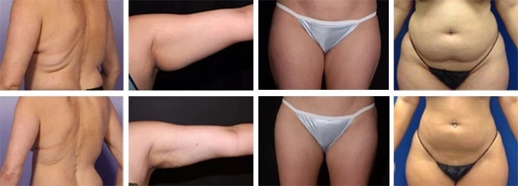 Для домашнего использования миниатюрный Липо лазер двойная длина волны 650nm lipo