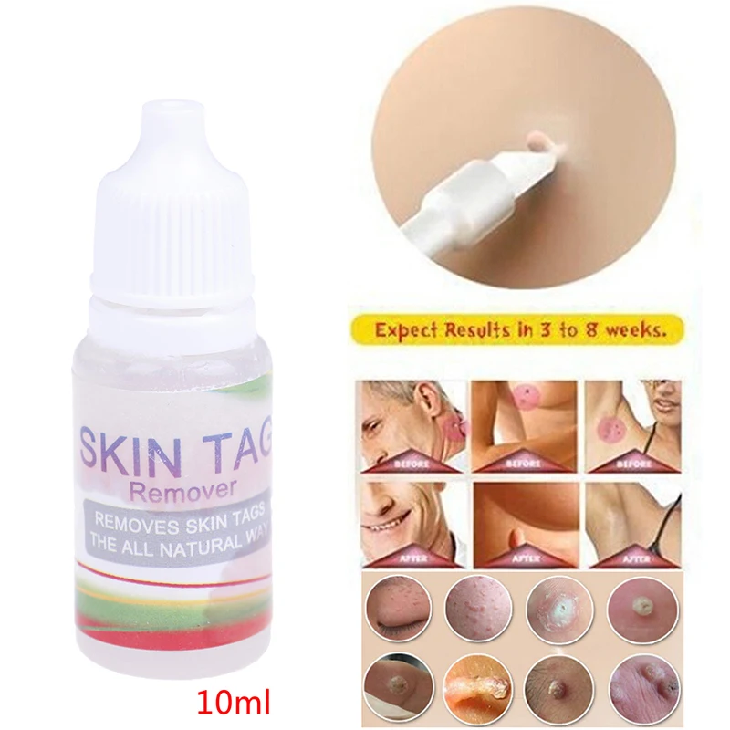 10 мл средство для удаления бородавок на моль и гениталию тегов кожу Tu Kill Medical Remover