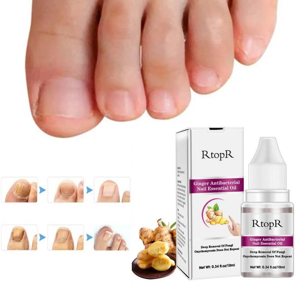 Имбирь лечения Ногтей онихомикоз паранихия анти грибковые инфекции ногтей