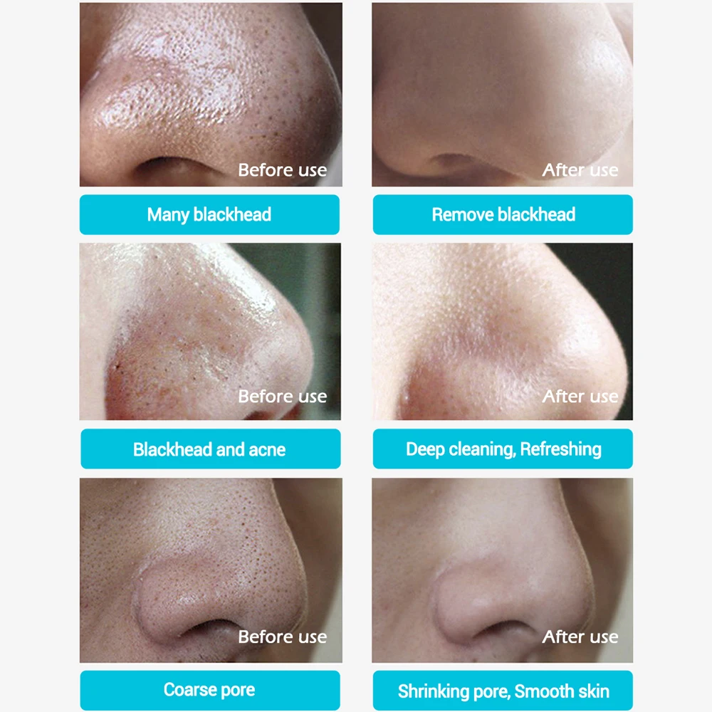 LANBENA средство для удаления угрей маска носа полоска пор черная отшелушивающая