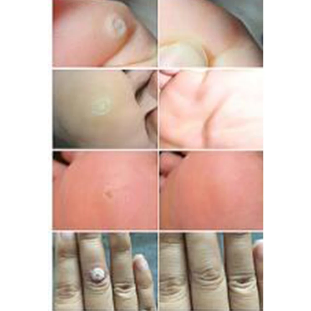 10g Effective Skin Tag Remover Natural Health Mole Nevus Wart Removal Foot Corn Warts Treatment Real massage D153 | Красота и