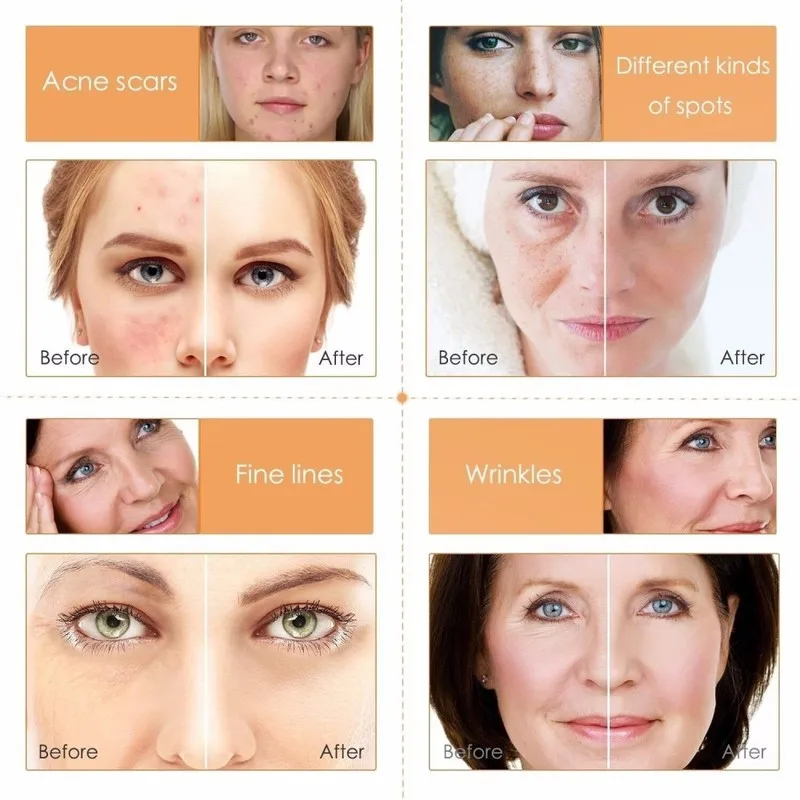 Лидер продаж 1 предмет с гиалуроновой кислотой Сыворотки содержит 20% витамин