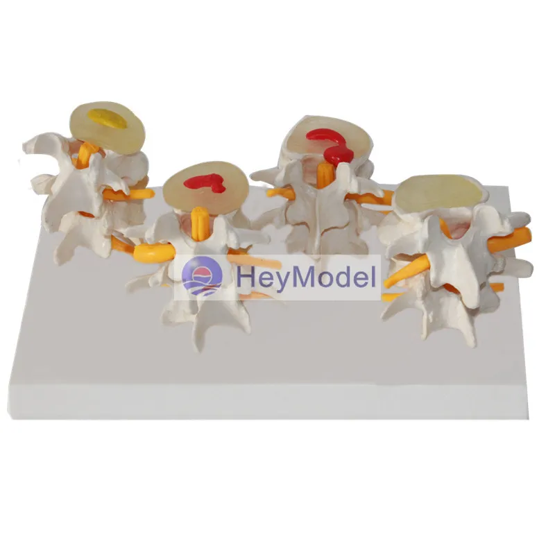 Четырехступенчатая поясничная модель позвоночника HeyModel костные шпоры