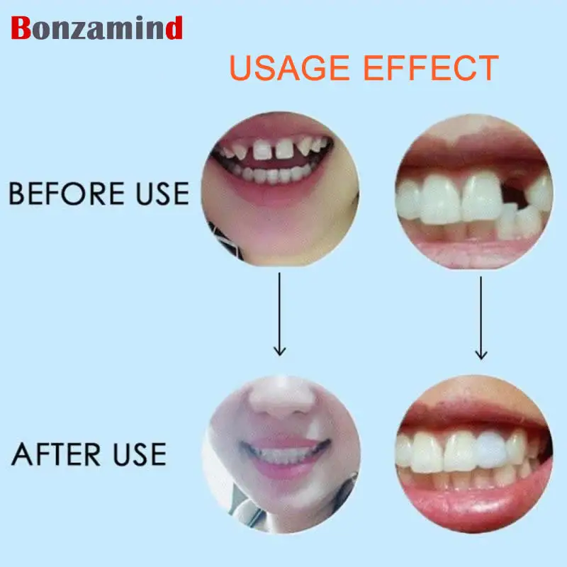 Гелевые виниры для зубов умеренная идеальная улыбка прозрачное отбеливание