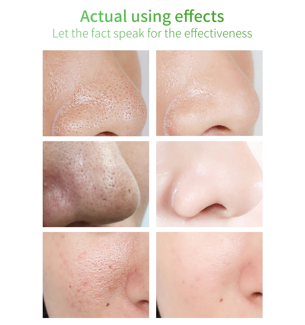 LANBENA beauty уход за кожей с сывороткой удаление черных точек сужение пор пилинг лечение акне рафинирование эссенция Глубокая чистка гладкая