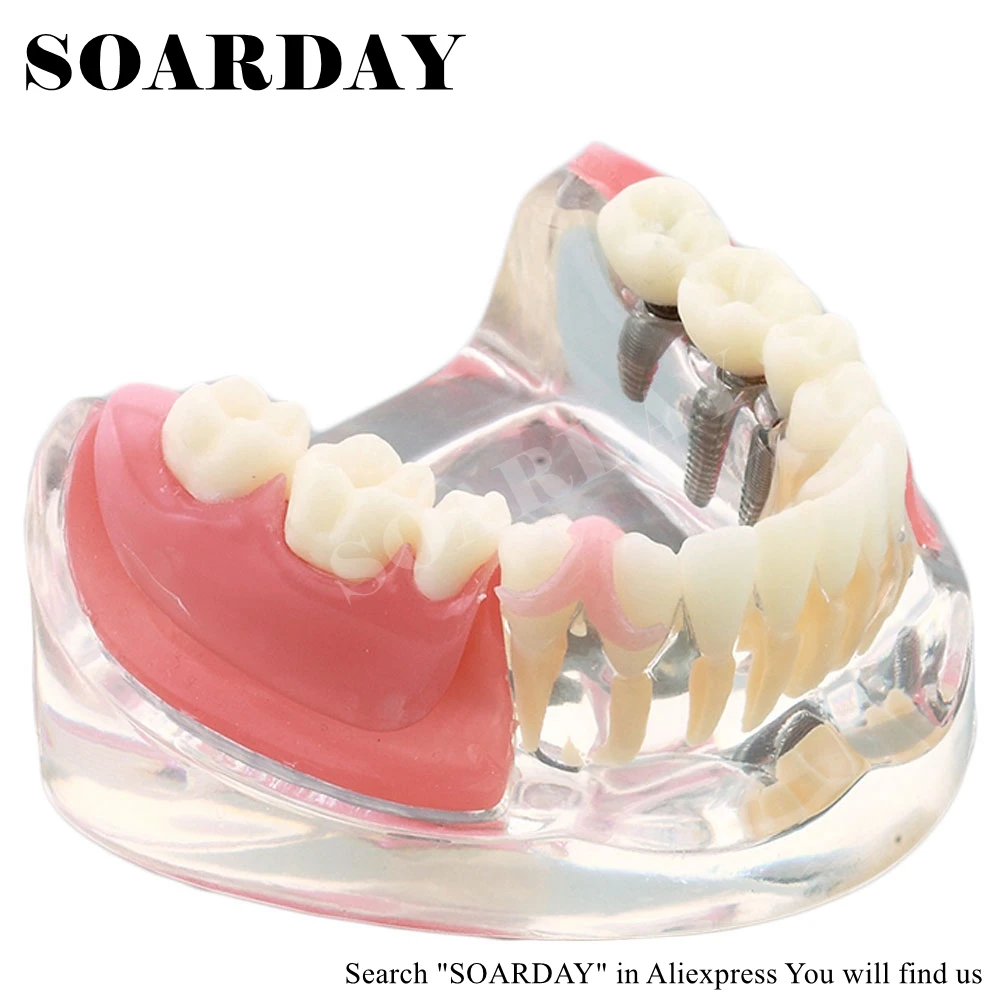 Модель имплантации и коррекции зубов SOARDAY модель анатомической анатомии
