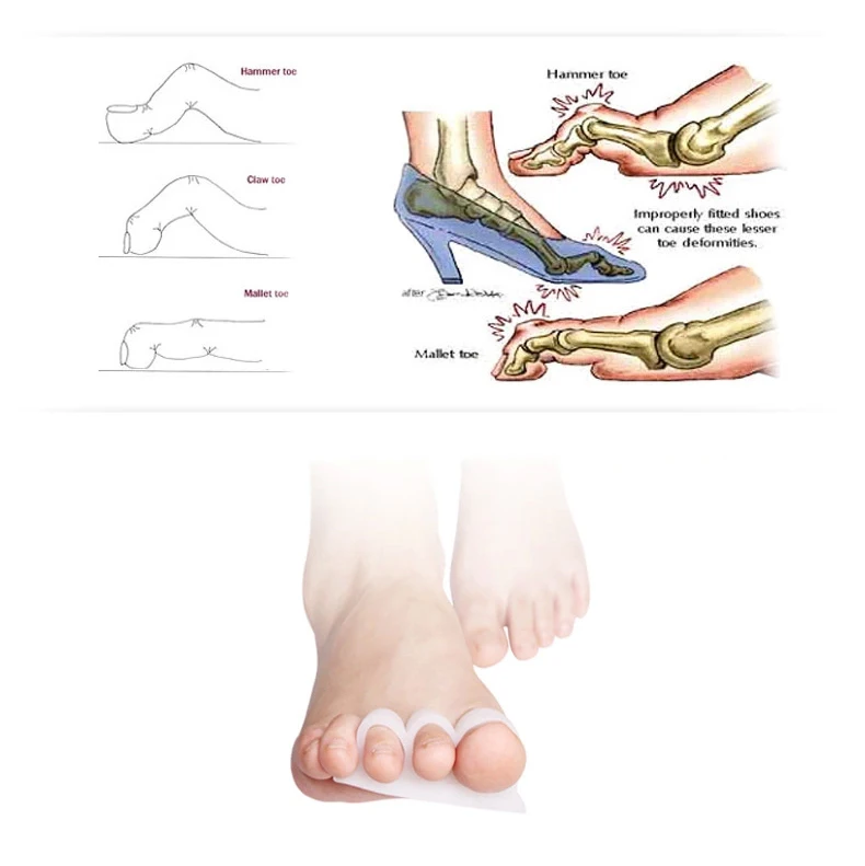 1 пара разделитель для костей при вальгусной деформации|toe separator|toes overlappinghallux valgus |