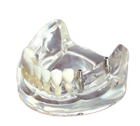 

Free Shipping Implant model for teaching dental tooth teeth dentist anatomical anatomy model odontologia