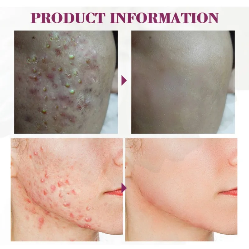 Propolis Repair Осветляющий очищающий Сужающий поры устраняет лечение от прыщей, отбеливание акне Remaval Cream