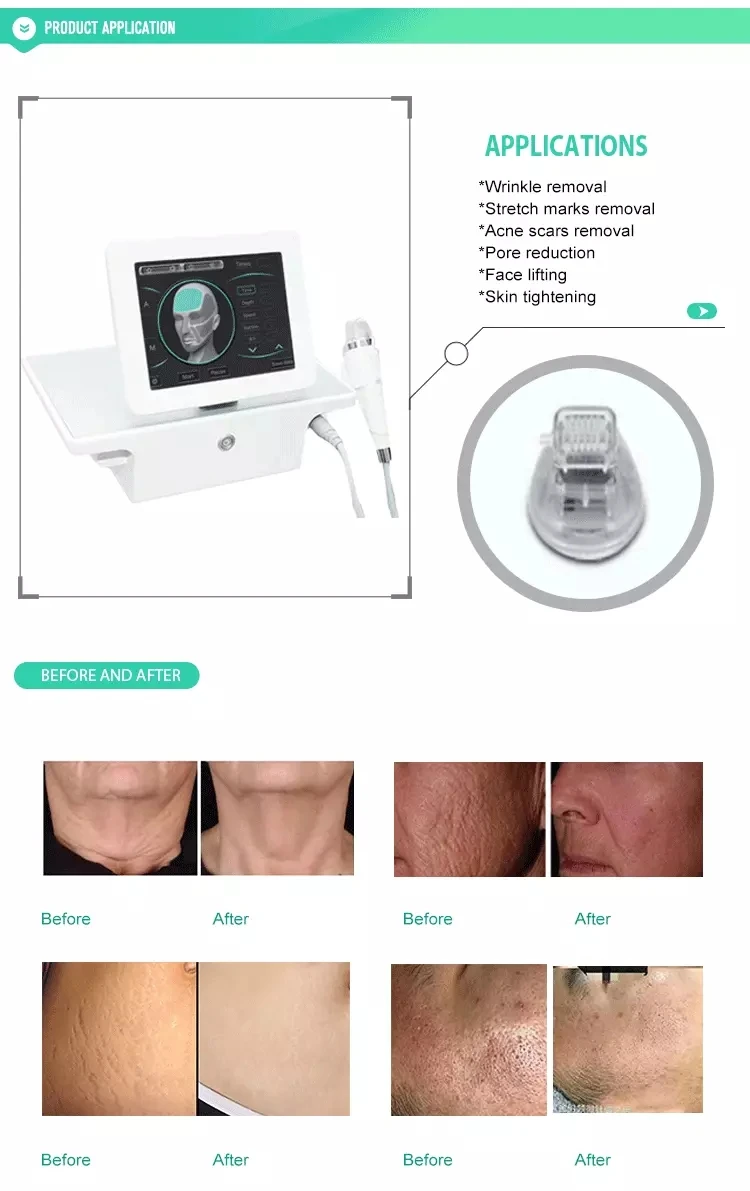 Лучшее оборудование для красоты лица радиочастотная микроигла rf фракционная и фракционная микроигла rf