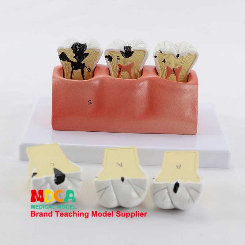 

Dental caries decomposition model dentistry oral dentistry display medical teaching model MYC008