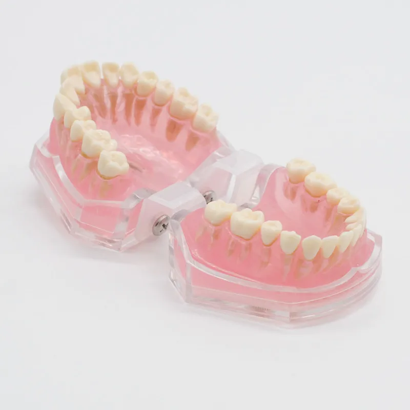 Стоматология лабораторная модель исследования зубов Overdenture Нижняя 4 имплантата