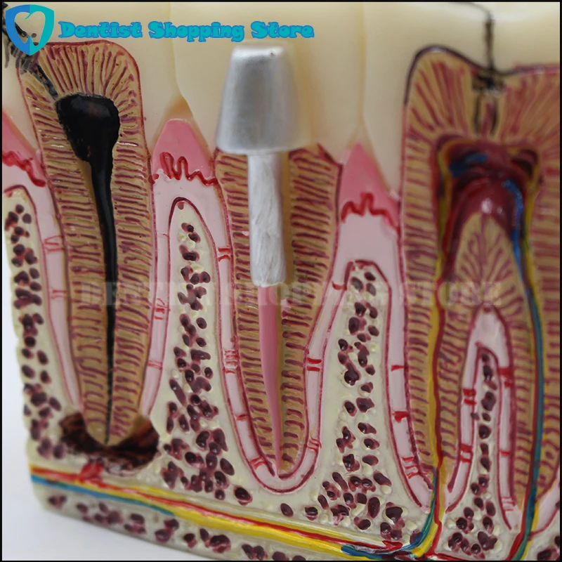 

High Quality Caries Tooth Model Dentist Patient Communication Anatomy Model Dentistry Rich Details Teaching Aids Equipment
