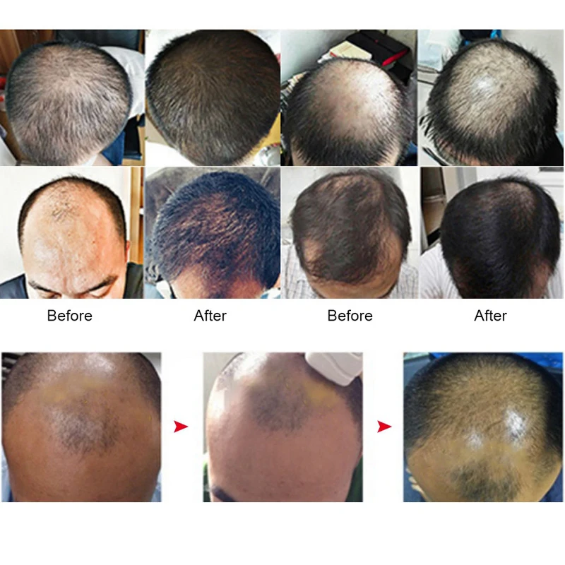 Лазерный шлем SIDEY для роста выпадения волос медицинские диоды лечение быстрое