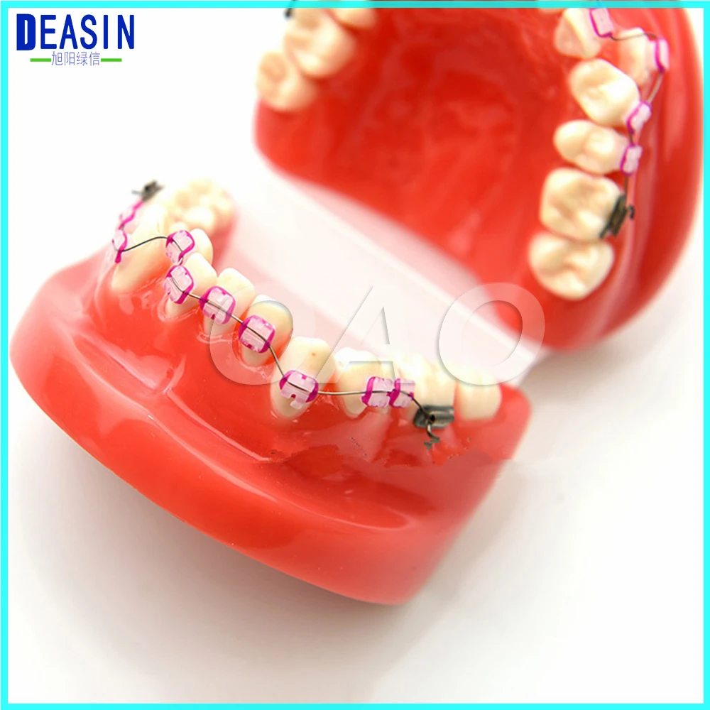 

Ortho Dontists Model with Metal Brackets Irregular Teeth