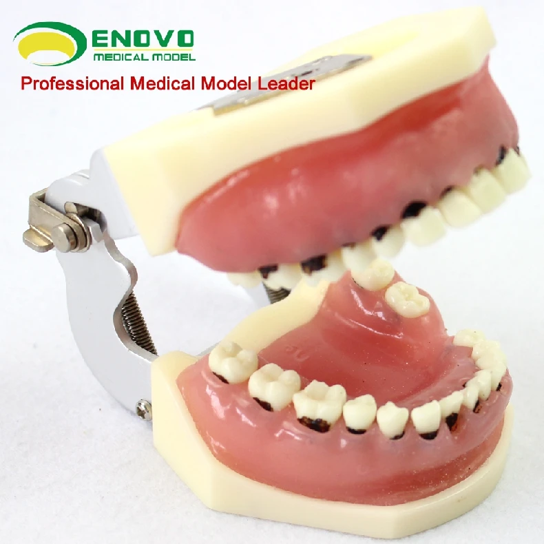 

Dental Severe Dentistry Periodontal Model Dental calculus Scaling Gingival suture Model Dividing