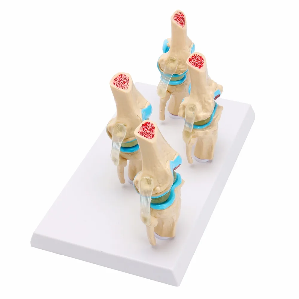 Один комплект коленного сустава 4 ступенчатый остеоар трит анатомическая модель