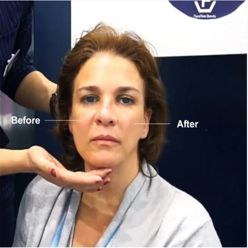 

2019 new Smart skin rejuvenation device beauty nanoskin face wrinkle and anti-aging device for face lifting tighting