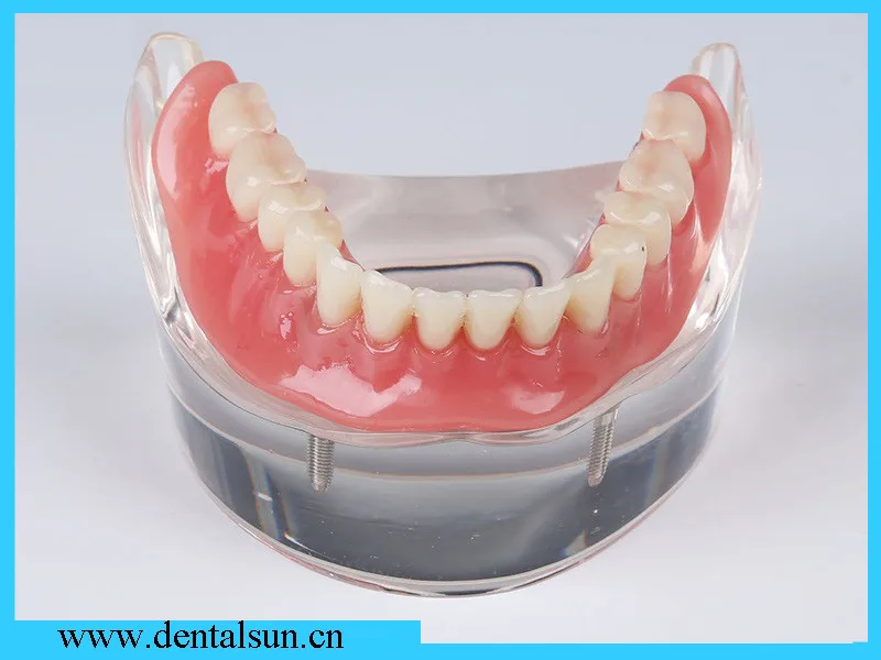 Приспособления для зубных имплантатов и мостовой абутмент зубов/протезная