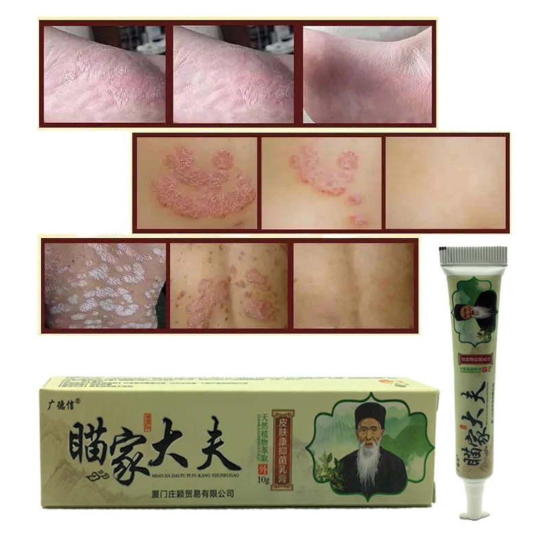 

100% Natural Herbal Creams Body Psoriasis Cream Perfect For Dermatitis and Eczema Pruritus Psoriasis Skin Problem Plaster