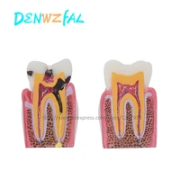 six fold dental caries contrast model dental decay demonstration model sectional model doctor patient communication for teaching