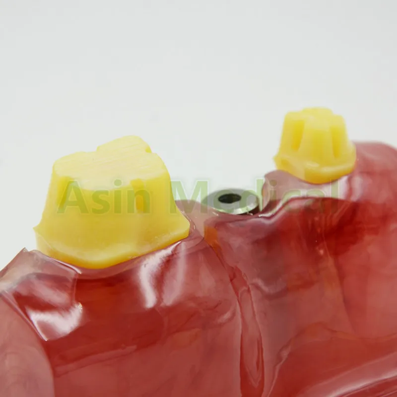 

NEW ARRIVAL MACRO IMPLANT MODEL CROWN BRIDGE DEMOSTRATATION TEETH TOOH TYPODONT DENTOFORM