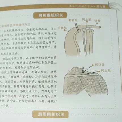 Графическая иглоукалывание и прижигание Daquan китайские книги по медицине zhong yi zhen