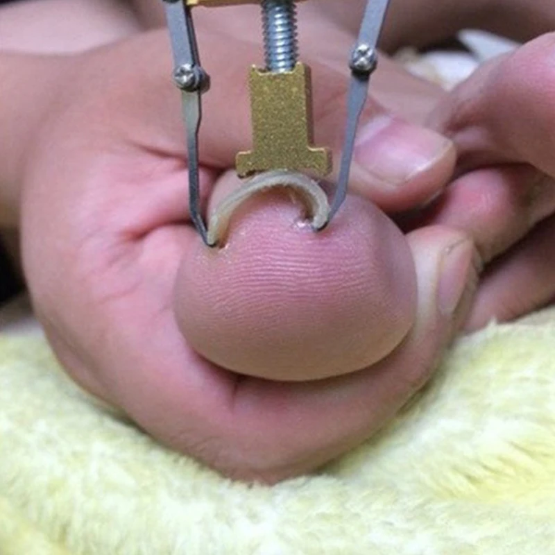 Nail Aligner Ingrown Toe Recover Correction Pedicure Tool Gold Silver Color Metal Foot Fixer Art Design Care Tools | Красота и