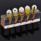 Эндодонтическая патологическая модель, модель для общения с пациентом, Эндодонтическое лечение, восстановление задней зубной целлюлозы