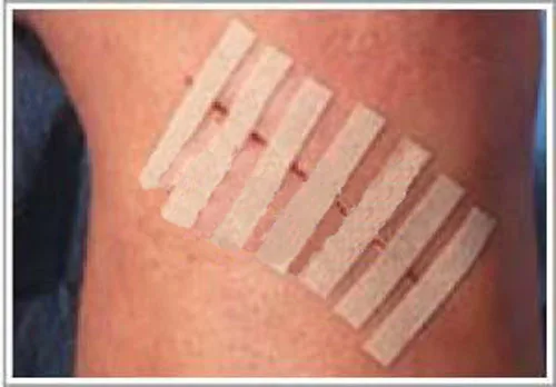 50 шт. 6 мм * 100 медицинский клей стерильные закрывающие кожу одноразовые