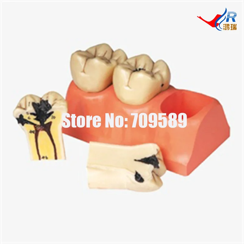 Dissected Model of Dental Caries, Dental Care Model