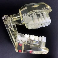 dental implant disease teeth model with restoration bridge malocclusion orthodontic model for medical science dental research