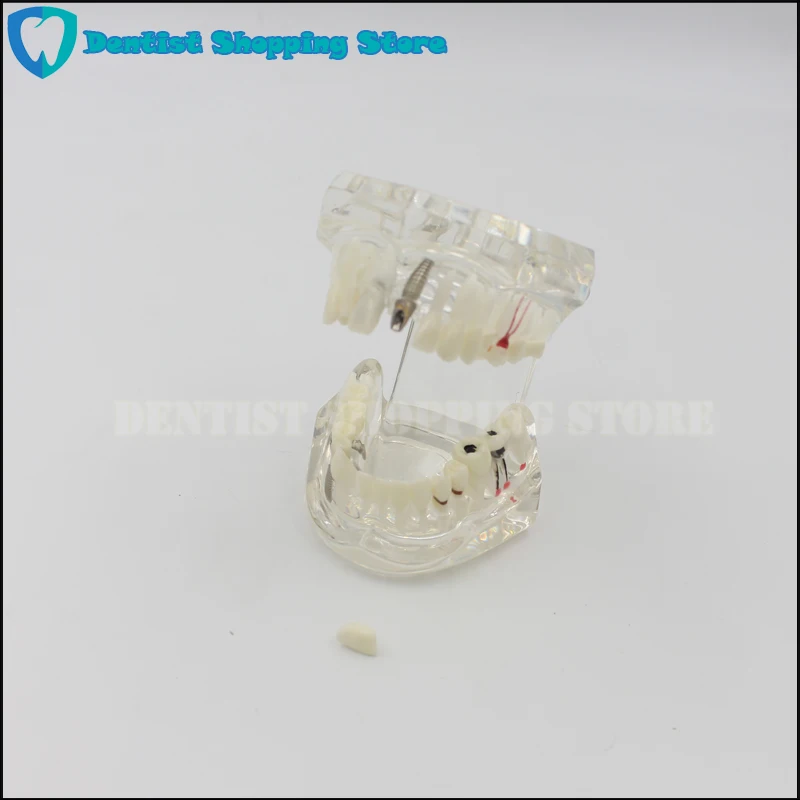 

Oral Clinic Transparent Adult Dental Restoration Bridge Tooth Model Removable Dentist Teaching Dental Implant Study
