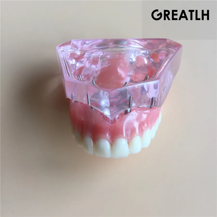 Модель зубного имплантата зубные зубы модель|dental tooth|teeth modeltooth teeth |
