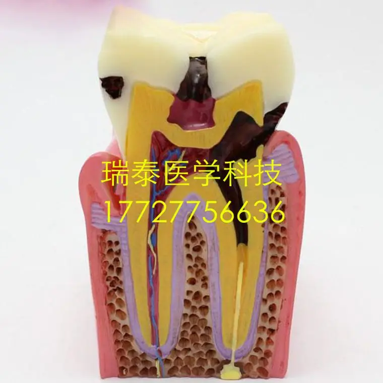 6X,9*7.6cm,Medical advanced resin dental Tooth model Doctor-patient communication teaching
6X,9*7.6cm,Medical advanced resin dental Tooth model Doctor-patient communication teaching
