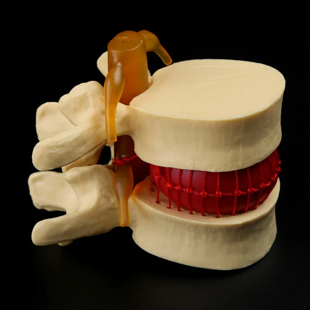 Anatomical Spine Lumbar Disc Herniation Anatomy Medical Model Teaching Tool School Supplies Instrume C26 | Канцтовары для офиса и