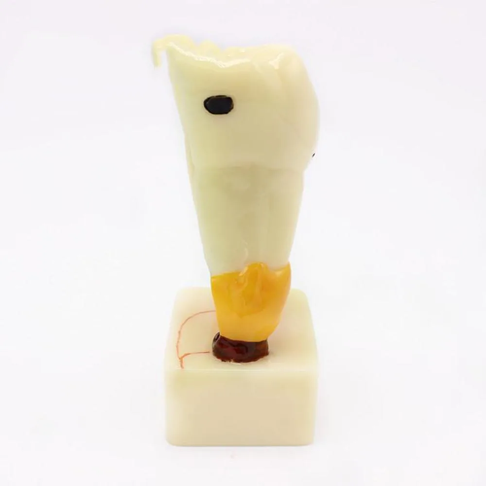 Модель анатомии для выполнения обычных патологий зубов модель кариес