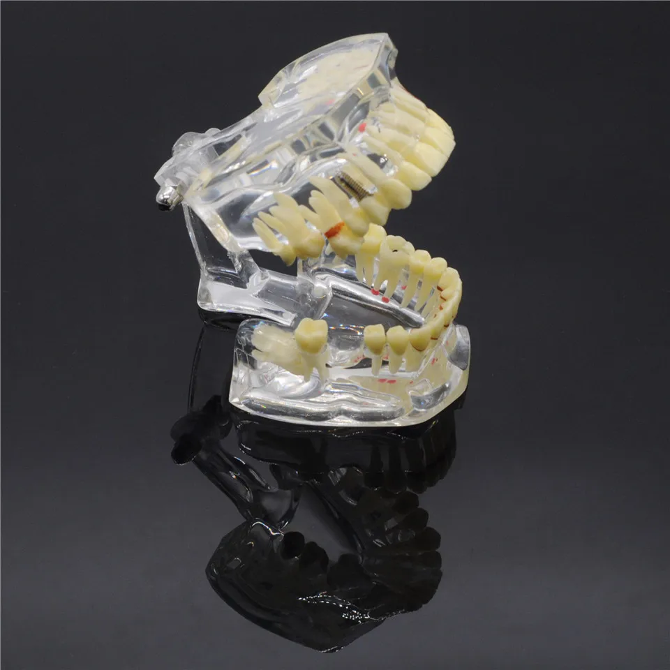 1 шт. деталь для имплантации зубов | Красота и здоровье