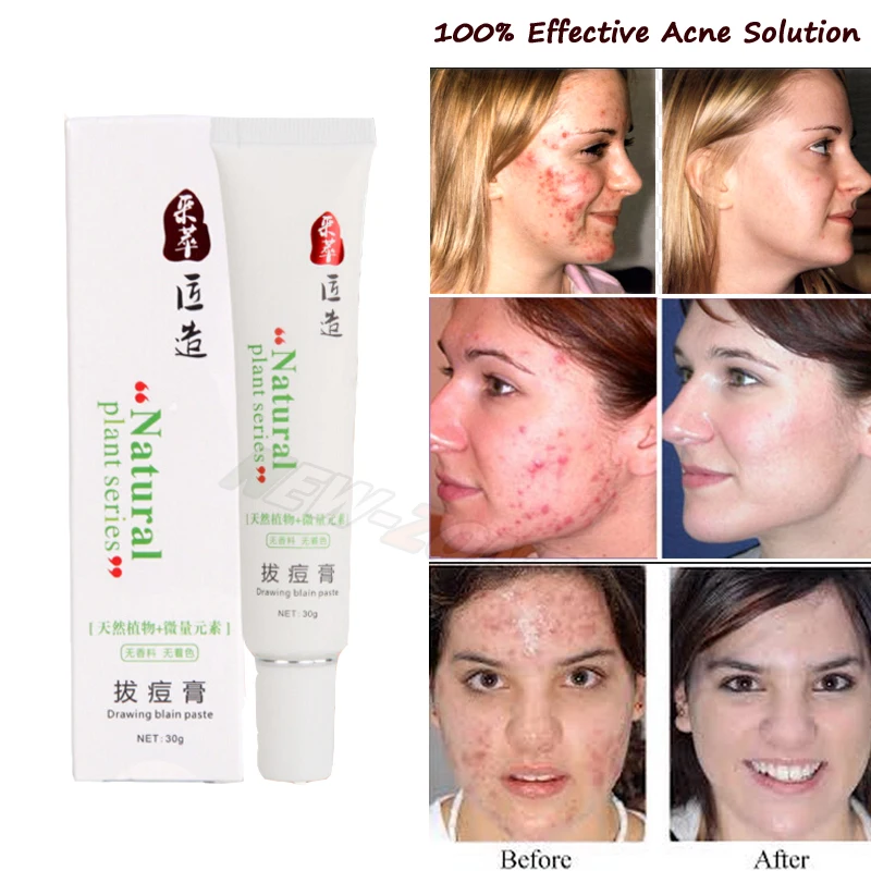 100% эффективный крем для акне женские и мужские прыщи быстрое лечение шрамы