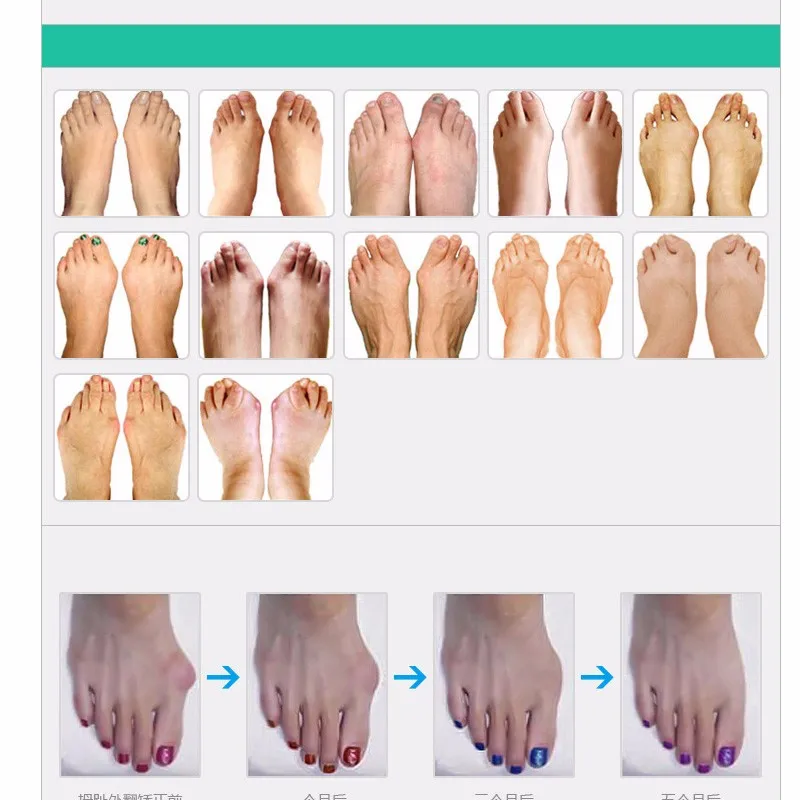 2 пары силиконовый гель Бурсит большого пальца стопы сепаратор ортопедический