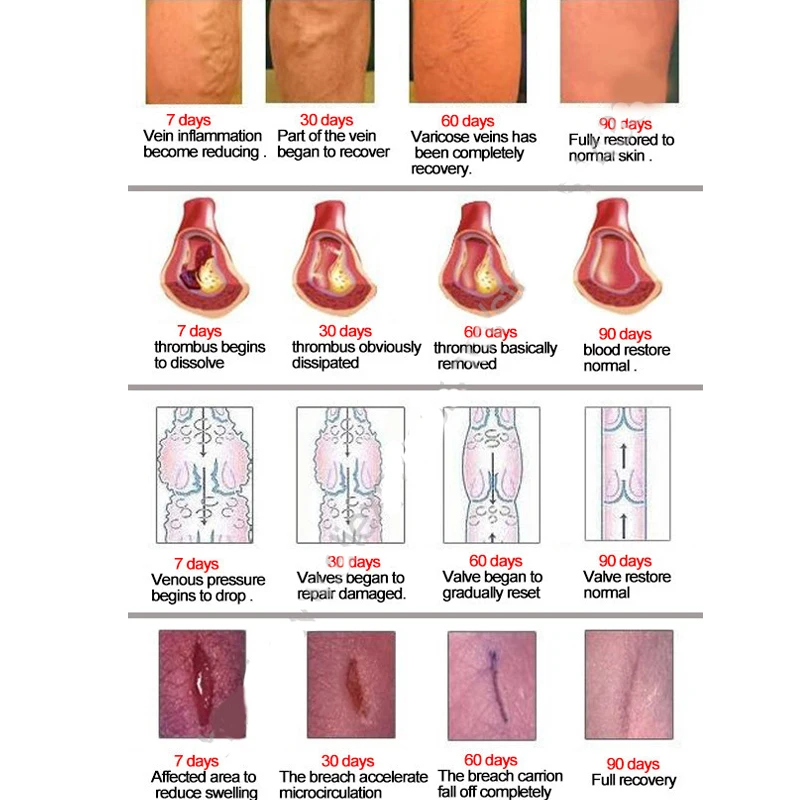 2 шт. варикозный медицинский лекарт против варикозного расшрения вен крем для