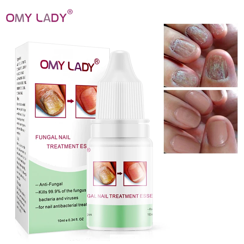 OMY LADY 3 шт. средство для лечения грибков ногтей эссенция и отбеливание ног