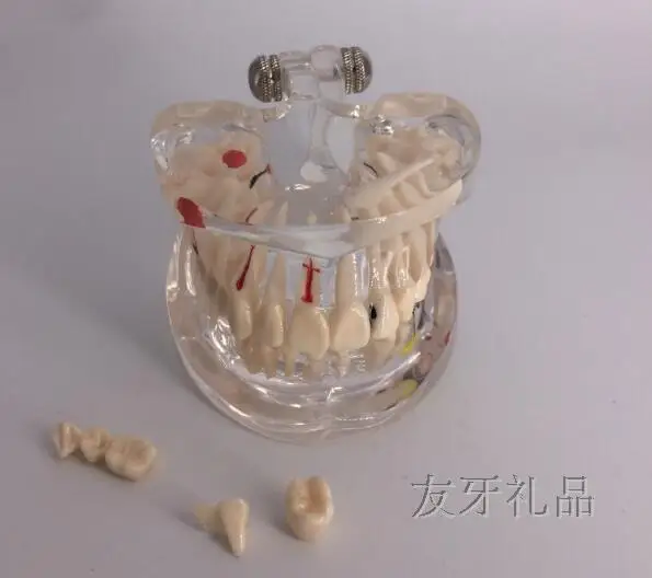 Медицинская наука Зуб модель взрослые прозрачные патологические