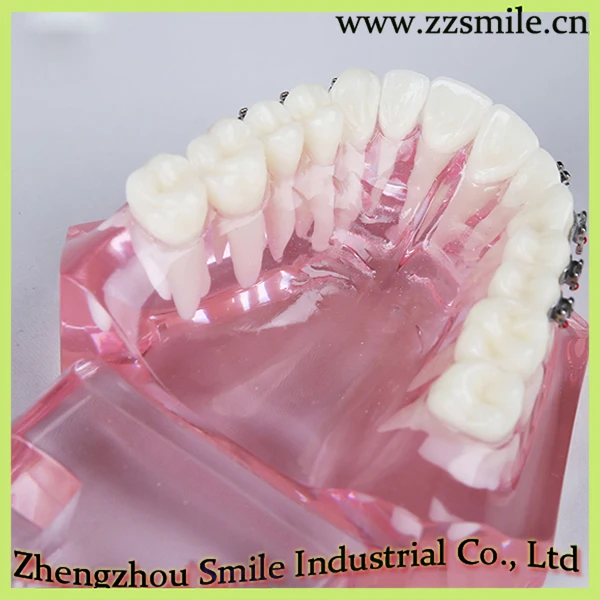 

Dental Study Teeth Model with metal Orthodontic Bracket M3001