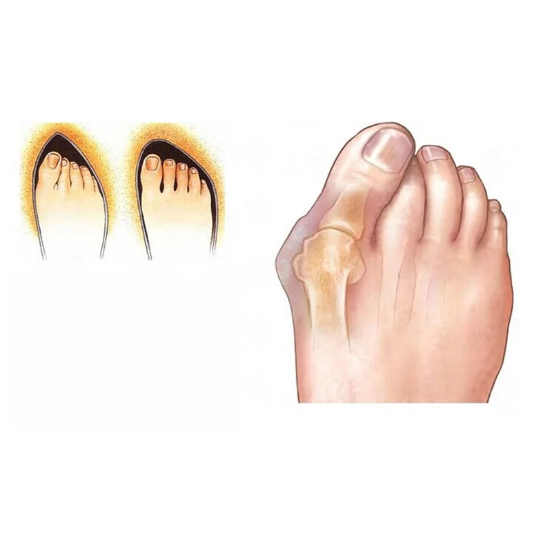 1 пара гелевый силиконовый корректор для сращивания Juanetes hallux valgus pro разделители