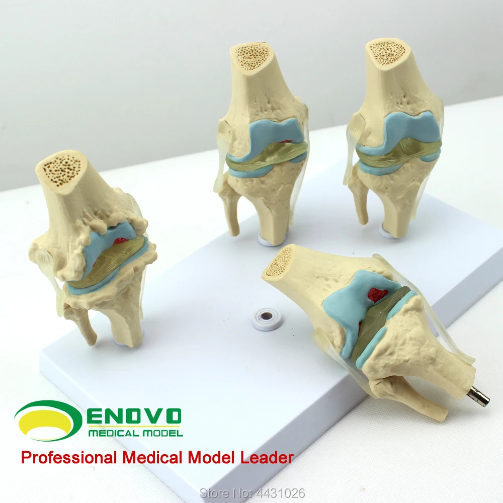 

ENOVO Human pathological knee model degenerative hemophilia orthopedic pain tube bone model