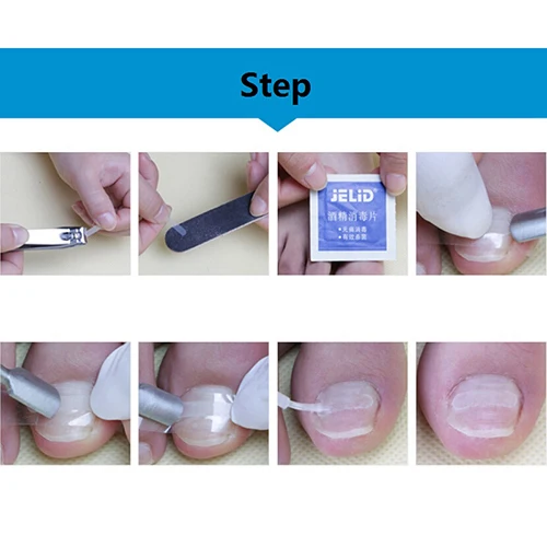 1 шт. фиксатор педикюр восстановление ногтей ног Коррекция файл корректор Уход за